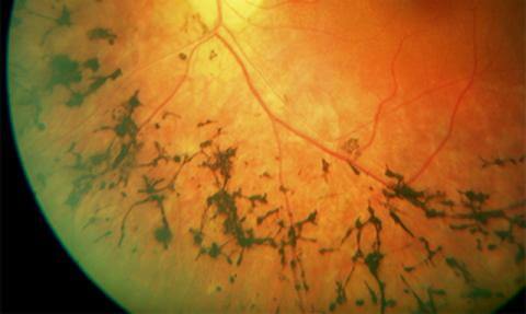 Trattamento della retinite pigmentosa